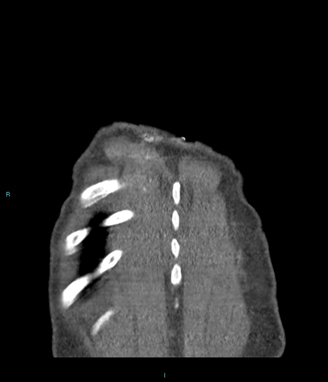 Calcified cerebral emboli from left ventricular thrombus (Radiopaedia 84420-99760 Coronal C+ CTPA 5).jpg