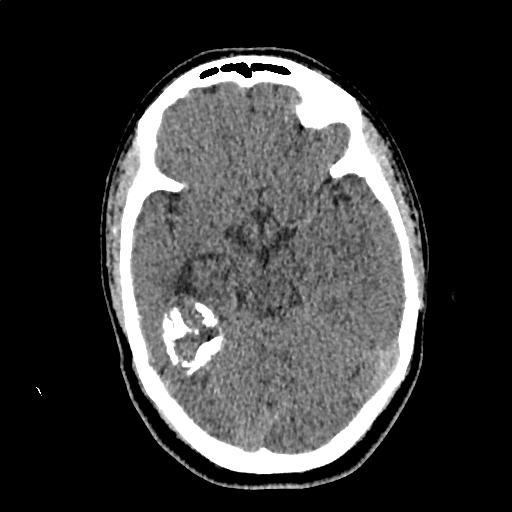 Calcified cerebral hydatid cyst (Radiopaedia 65603-74717 Axial non-contrast 24).jpg