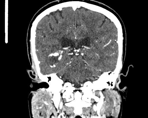Calcified cerebral hydatid cyst (Radiopaedia 65603-74717 C 45).jpg
