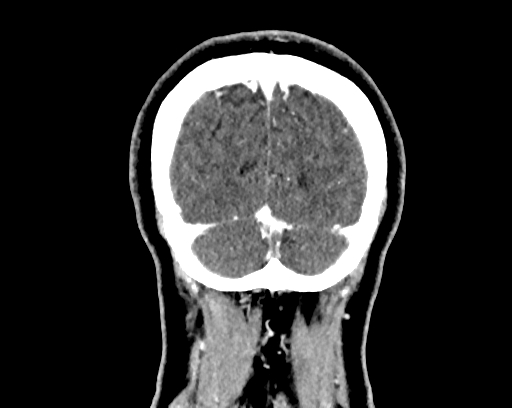 Calcified cerebral hydatid cyst (Radiopaedia 65603-74717 C 67).jpg