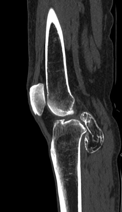 Calcified hematoma - popliteal fossa (Radiopaedia 63938-72763 Sagittal bone window 51).jpg