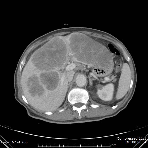 Calcified liver metastases (Radiopaedia 44699-48470 B 24).jpg