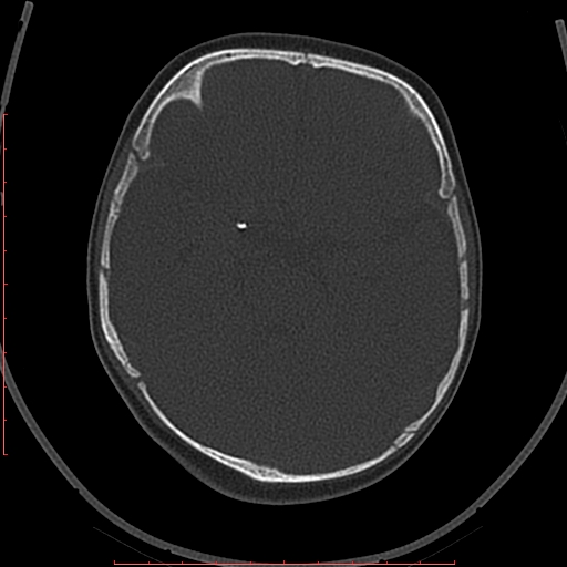 Calcified middle cerebral artery embolism (Radiopaedia 78949-91860 Axial bone window 19).jpg