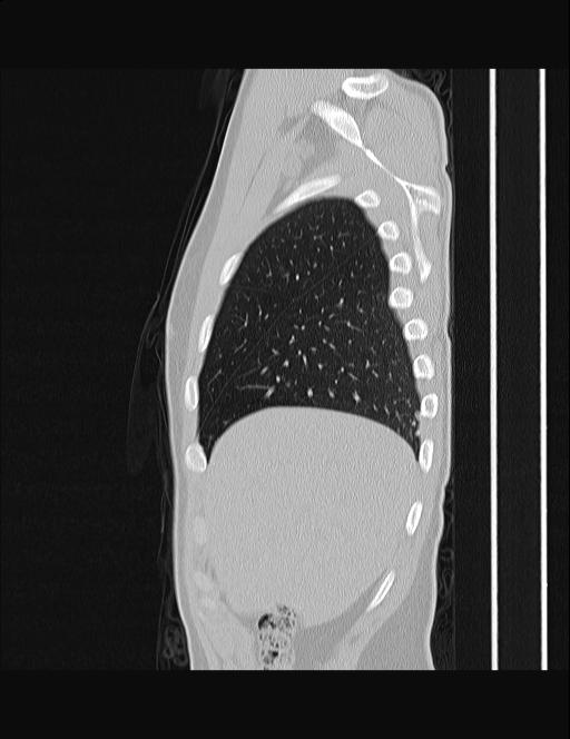 Calcifying pulmonary metastases (Radiopaedia 33359-34396 Sagittal lung window 60).jpg