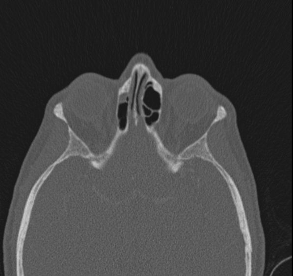 Caldwell-Luc operation (Radiopaedia 52329-58225 Axial bone window 20).jpg
