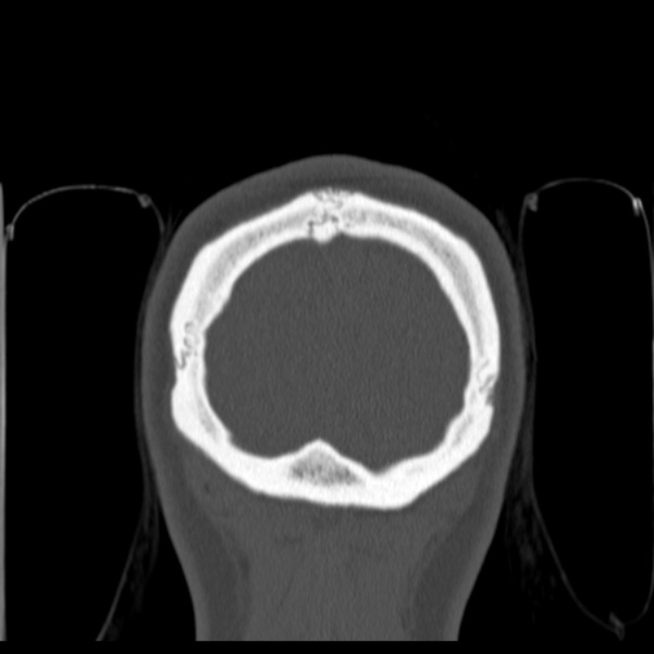 Calvarial osteoma (Radiopaedia 36520-38079 C 89).jpg