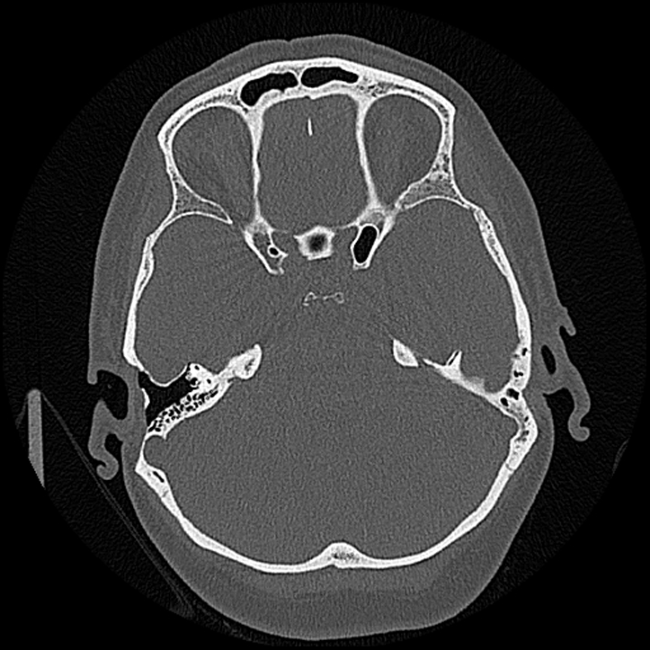 Canal up mastoidectomy (Radiopaedia 78108-90638 Axial bone window 103).jpg