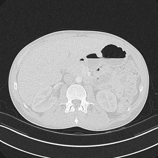 Cannonball metastases - testicular choriocarcinoma (Radiopaedia 84510-99891 Axial lung window 109).jpg