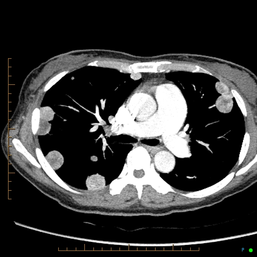 Canonball lung metastasis (Radiopaedia 77634-89837 B 40).jpg