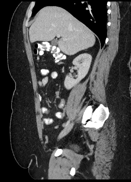 Carcinoid tumor - terminal ileum (Radiopaedia 60931-68739 C 66).jpg