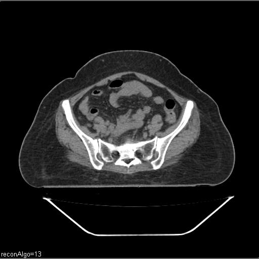 Carcinoma cervix- brachytherapy applicator (Radiopaedia 33135-34173 Axial non-contrast 11).jpg