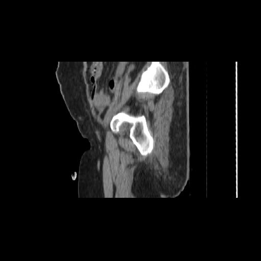 File:Carcinoma cervix- brachytherapy applicator (Radiopaedia 33135-34173 D 28).jpg
