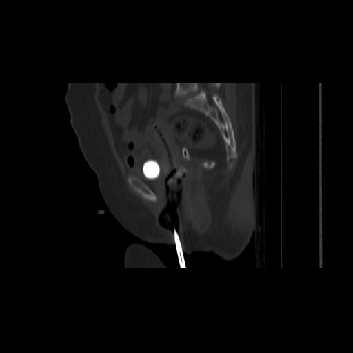 File:Carcinoma cervix- brachytherapy applicator (Radiopaedia 33135-34173 Sagittal bone window 81).jpg