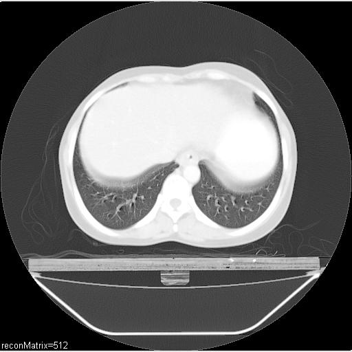 File:Carcinoma of esophagus (Radiopaedia 27356-27550 Axial lung window 9).jpg