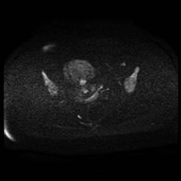 Carcinoma of the cervix (Radiopaedia 89018-105858 Axial DWI 75).jpg
