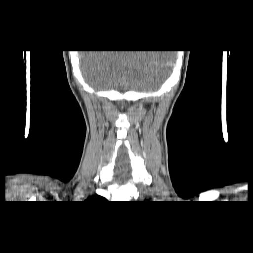 Carcinoma of the maxillary antrum (Radiopaedia 53805-59888 Coronal C+ delayed 135).jpg
