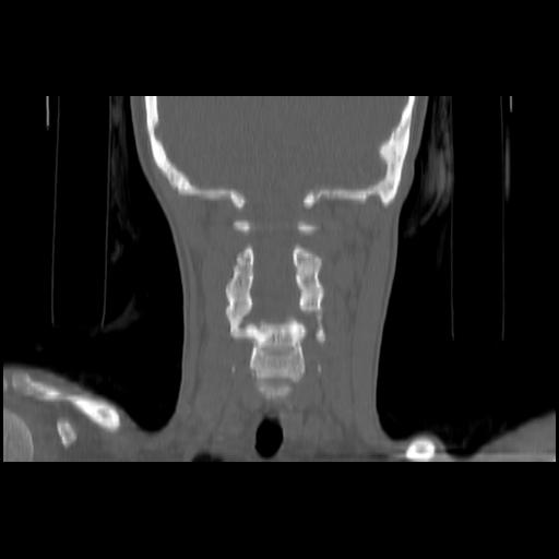 Carcinoma of the maxillary antrum (Radiopaedia 53805-59888 Coronal bone window 110).jpg