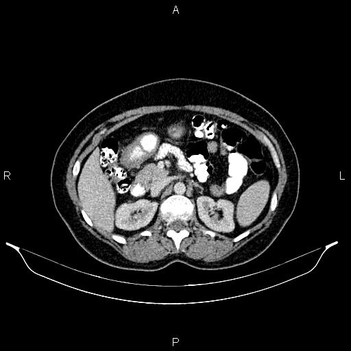 Carcinoma of uterine cervix (Radiopaedia 85861-101700 A 41).jpg