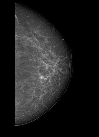 File:Cardiac pacemaker (mammography) (Radiopaedia 72298-82831 L CC 1).PNG
