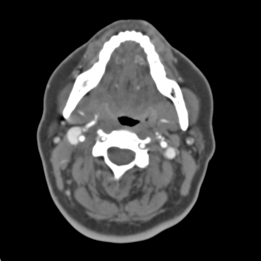 Carotico ophthalmic aneurysm (Radiopaedia 42916-46148 A 61).png