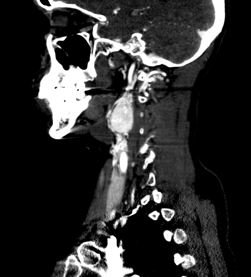 File:Carotid body tumor (Radiopaedia 39845-42300 D 42).jpg