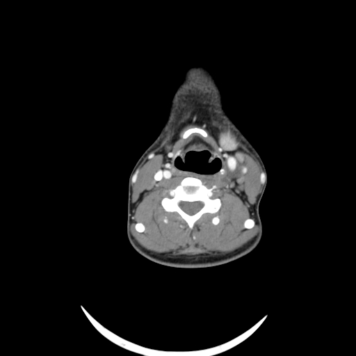 Carotid bulb pseudoaneurysm (Radiopaedia 57670-64616 A 40).jpg