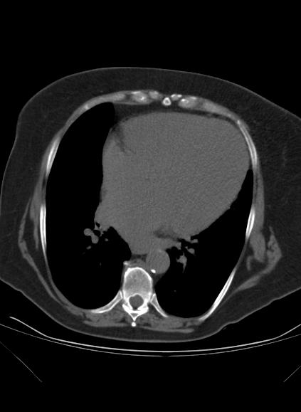 File:Caseous mitral annular calcification (Radiopaedia 61219-69122 Axial non-contrast 10).jpg