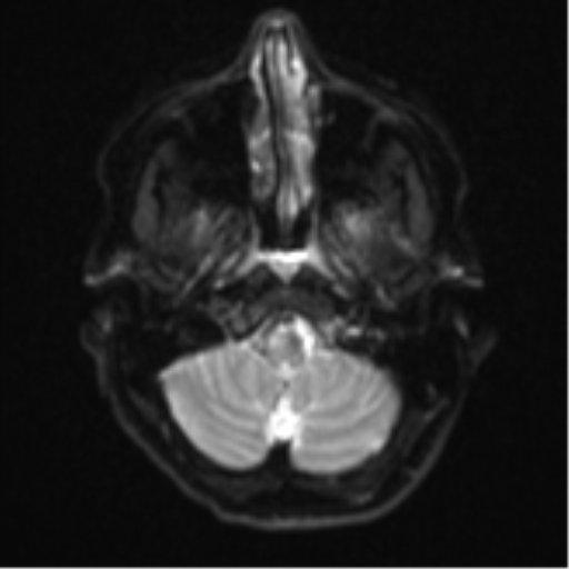 File:Cavernoma with bleed - midbrain (Radiopaedia 54546-60774 Axial DWI 3).png