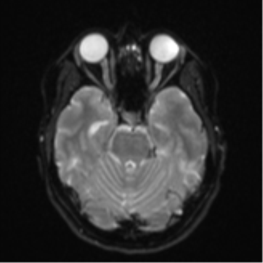 File:Cavernoma with bleed - midbrain (Radiopaedia 54546-60774 Axial DWI 8).png