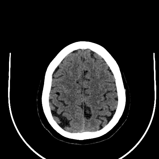 Cavernous hemangioma of the cerebellar falx (Radiopaedia 73025-83723 Axial non-contrast 107).jpg