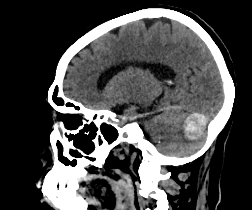 Cavernous hemangioma of the cerebellar falx (Radiopaedia 73025-83723 B 199).jpg