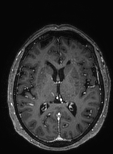 Cavernous hemangioma of the cerebellar falx (Radiopaedia 73025-83724 Axial T1 C+ 159).jpg