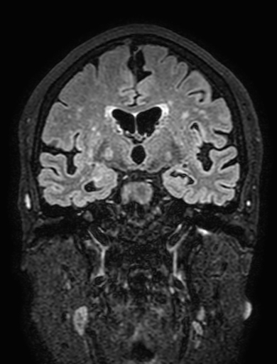 Cavernous hemangioma of the cerebellar falx (Radiopaedia 73025-83724 Coronal FLAIR 165).jpg