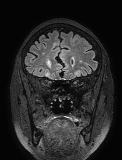 Cavernous hemangioma of the cerebellar falx (Radiopaedia 73025-83724 Coronal FLAIR 88).jpg