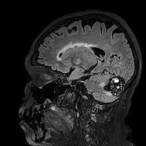 Cavernous hemangioma of the cerebellar falx (Radiopaedia 73025-83724 Sagittal FLAIR 139).jpg