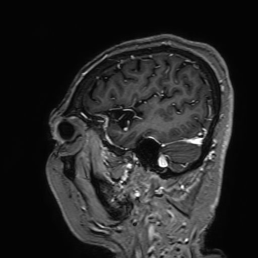 Cavernous hemangioma of the cerebellar falx (Radiopaedia 73025-83724 Sagittal T1 C+ 39).jpg