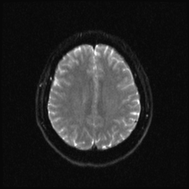 Cavernous sinus meningioma (Radiopaedia 63682-72367 DWI 16).jpg