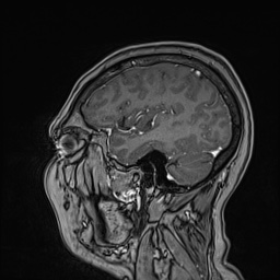 Cavernous sinus meningioma (Radiopaedia 63682-72367 Sagittal T1 C+ 130).jpg