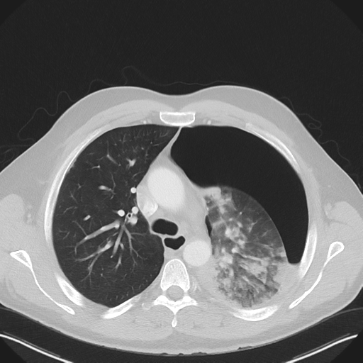 Cavitating pneumonia complicated by pneumothorax (Radiopaedia 48149-52994 Axial lung window 25).png