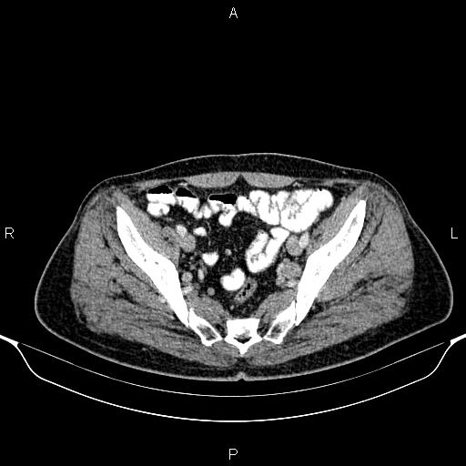 Cecal adenocarcinoma (Radiopaedia 85324-100916 B 82).jpg
