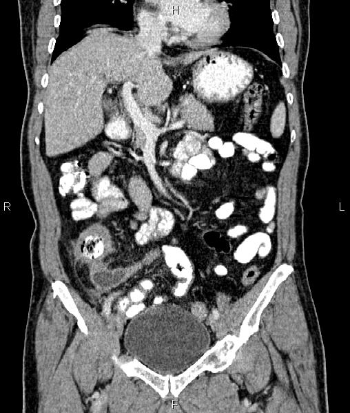 Cecal cancer with appendiceal mucocele (Radiopaedia 91080-108651 D 31).jpg