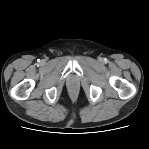 File:Cecal mass causing appendicitis (Radiopaedia 59207-66531 A 91).jpg
