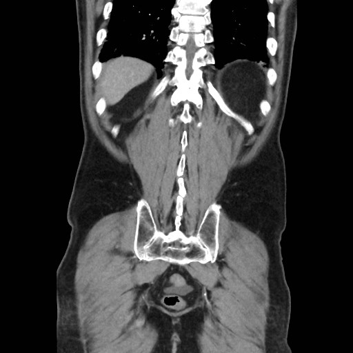 Cecal mass causing appendicitis (Radiopaedia 59207-66531 B 44).jpg