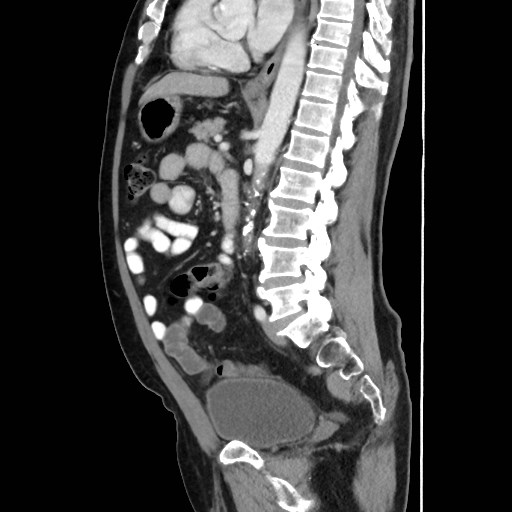 Cecal mass causing appendicitis (Radiopaedia 59207-66531 C 36).jpg