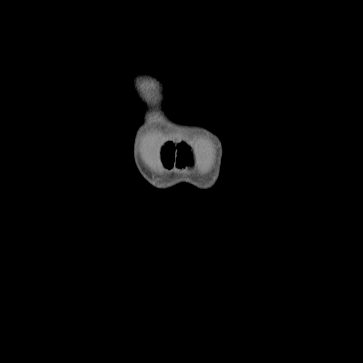 Cecal volvulus (Radiopaedia 69527-79408 B 4).jpg