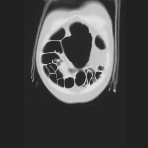Cecal volvulus (Radiopaedia 75378-86620 Coronal lung window 23).jpg