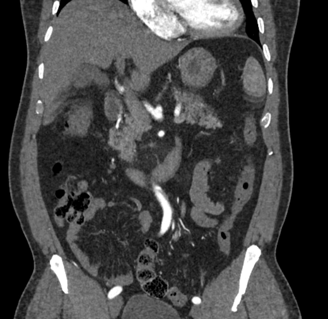 Celiac artery dissection (Radiopaedia 52194-58080 C 38).jpg