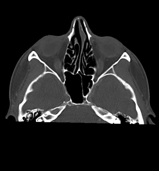 Cemento-ossifying fibroma (Radiopaedia 46243-50643 Axial bone window 20).png