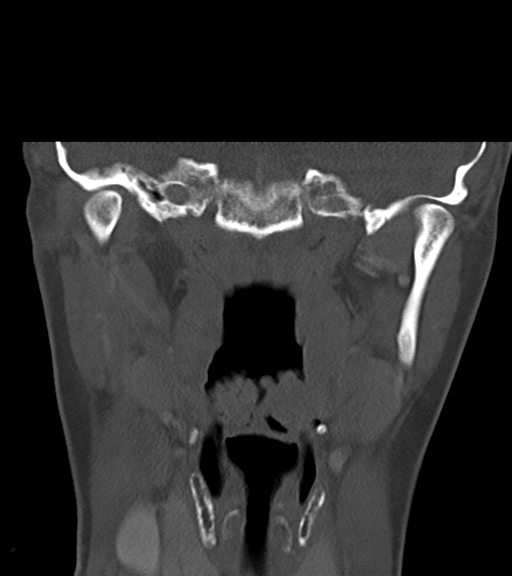 Cemento-ossifying fibroma (Radiopaedia 46243-50643 Coronal bone window 37).png