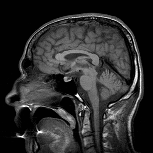 File:Central-variant posterior reversible encephalopathy syndrome (PRES) (Radiopaedia 43880-47359 Sagittal T1 12).jpg